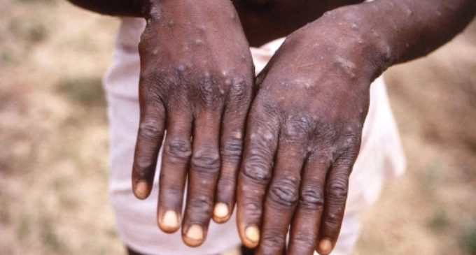 Centre holds high-level review meeting on Monkeypox after reports of fourth case in country