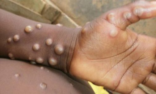Study finds current monkmonkeypox symptoms different from those in earlier outbreaks
