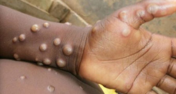 Study finds current monkmonkeypox symptoms different from those in earlier outbreaks